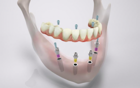 全口种植牙品牌有哪些？Camlog科美勒带你探究各价位种植体品牌！