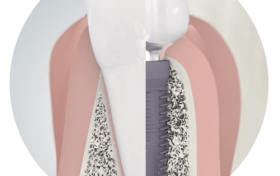 自身经历分享：老人做半口种植牙首选科美勒，安全安心！
